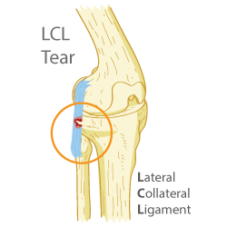 LCL Injuries