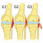 Recovery Times for an LCL Tear